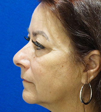 Blepharoplasty