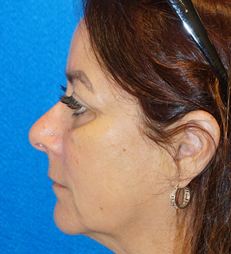 Blepharoplasty