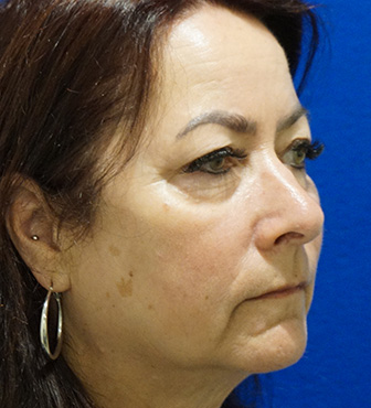 Blepharoplasty