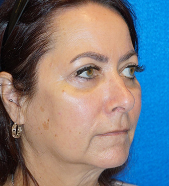 Blepharoplasty