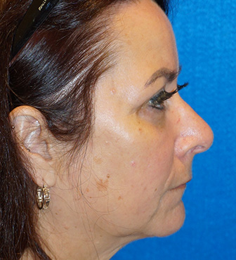 Blepharoplasty