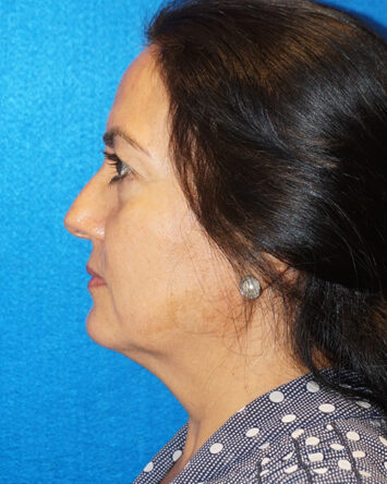 Facelift/Necklift