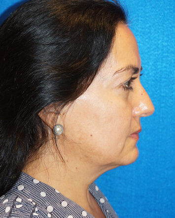 Facelift/Necklift