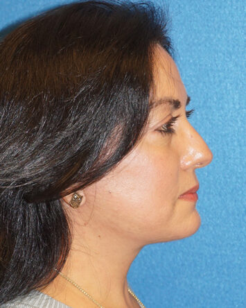 Facelift/Necklift