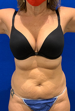 Tummy Tuck