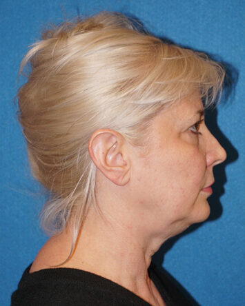 Facelift/Necklift