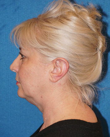 Facelift/Necklift