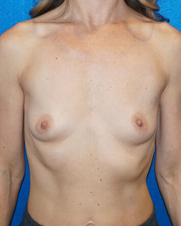 Breast Augmentation