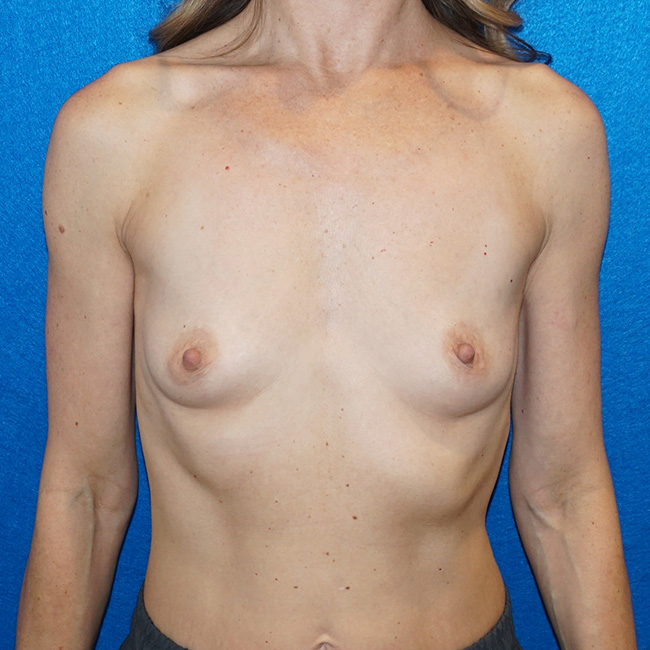 Breast Augmentation