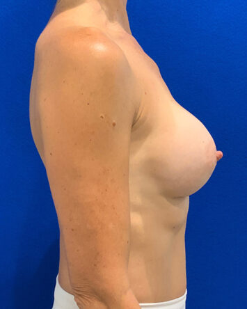 Breast Augmentation