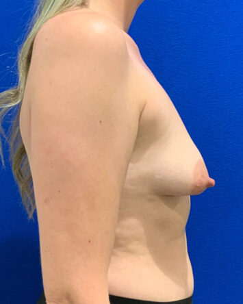 Breast Augmentation