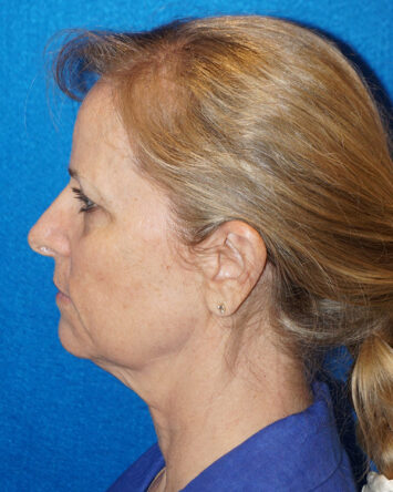 Facelift/Necklift