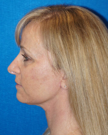 Facelift/Necklift