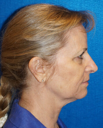 Facelift/Necklift