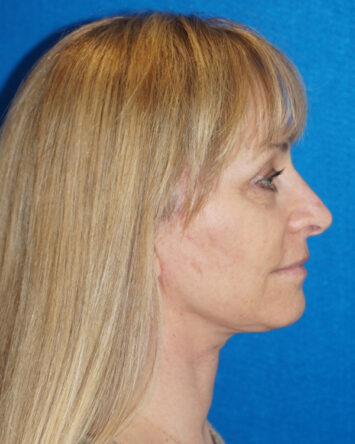 Facelift/Necklift