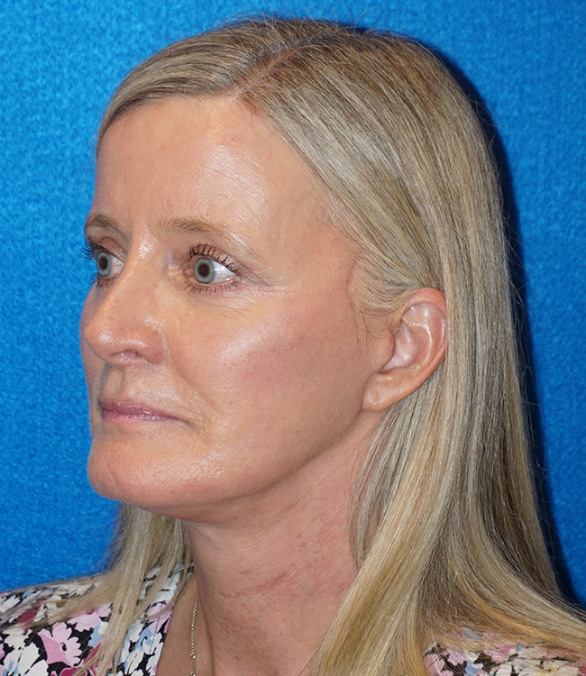 Facelift/Necklift