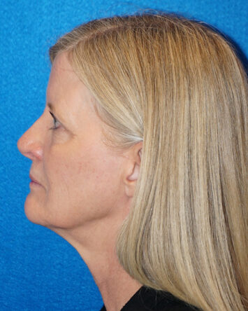 Facelift/Necklift