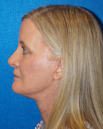 Facelift/Necklift