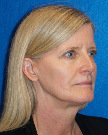 Facelift/Necklift