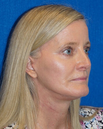 Facelift/Necklift