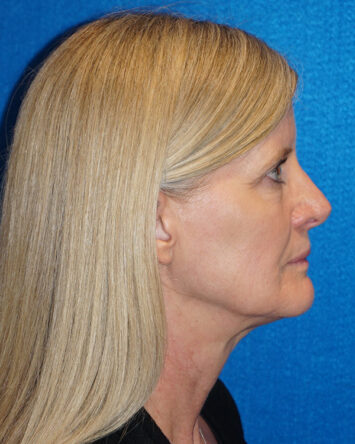 Facelift/Necklift