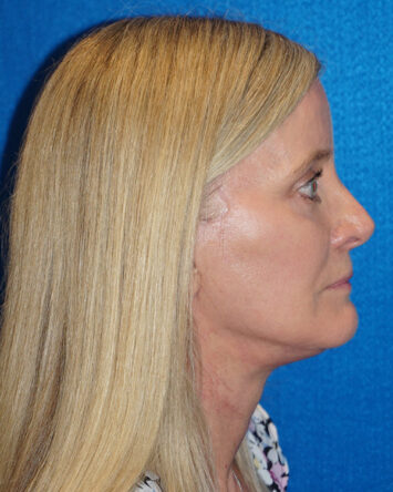 Facelift/Necklift