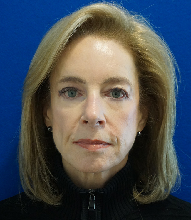 Facelift/Necklift