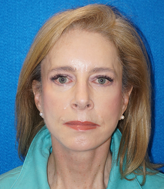 Facelift/Necklift