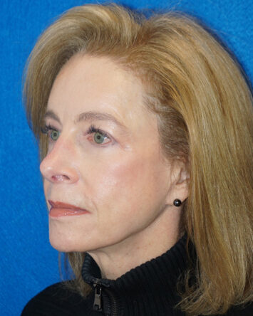 Facelift/Necklift