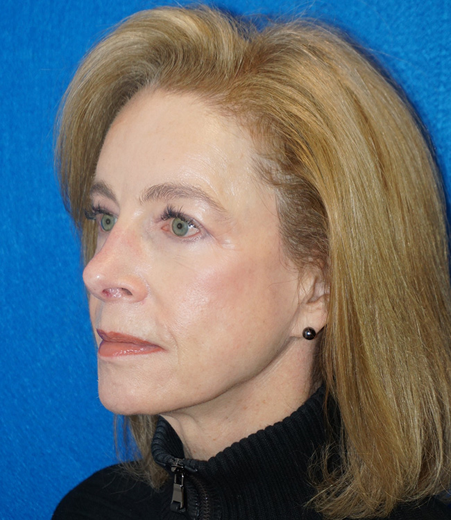 Facelift/Necklift