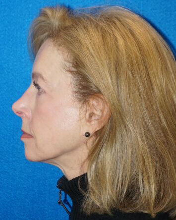 Facelift/Necklift