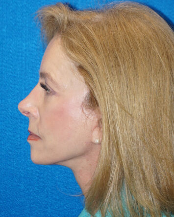 Facelift/Necklift