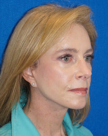 Facelift/Necklift