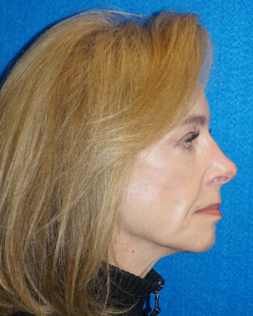 Facelift/Necklift