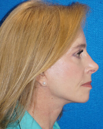 Facelift/Necklift