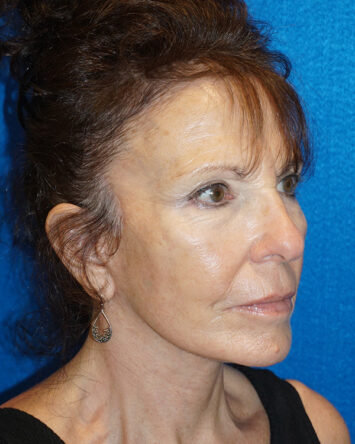 Facelift/Necklift