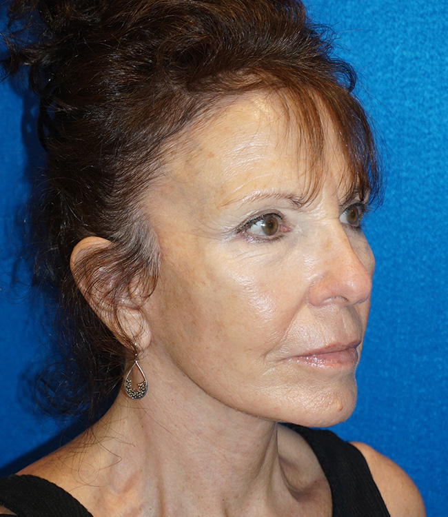 Facelift/Necklift