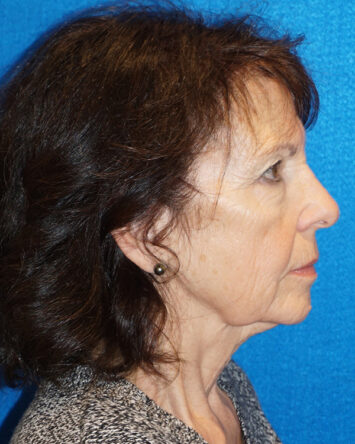 Facelift/Necklift