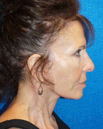 Facelift/Necklift