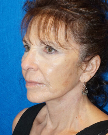 Facelift/Necklift