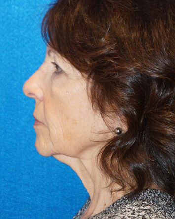 Facelift/Necklift