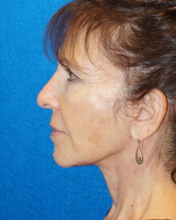 Facelift/Necklift