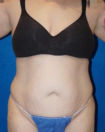 Tummy Tuck