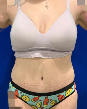 Tummy Tuck