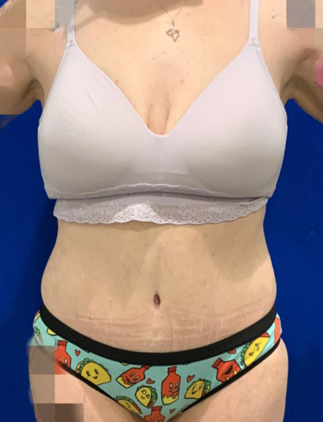 Tummy Tuck