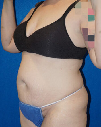 Tummy Tuck