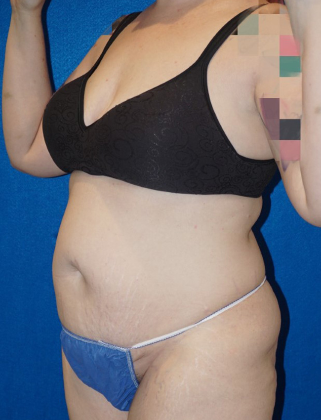 Tummy Tuck