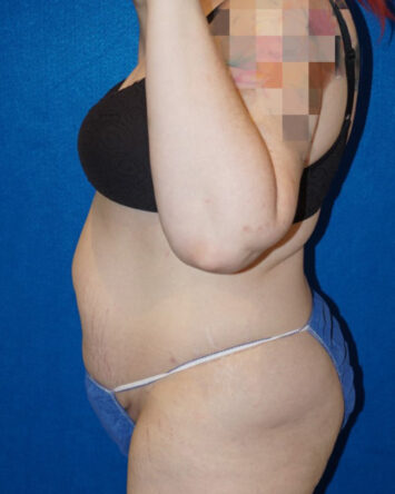 Tummy Tuck