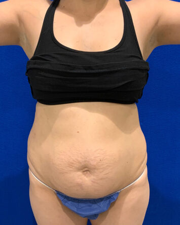 Tummy Tuck