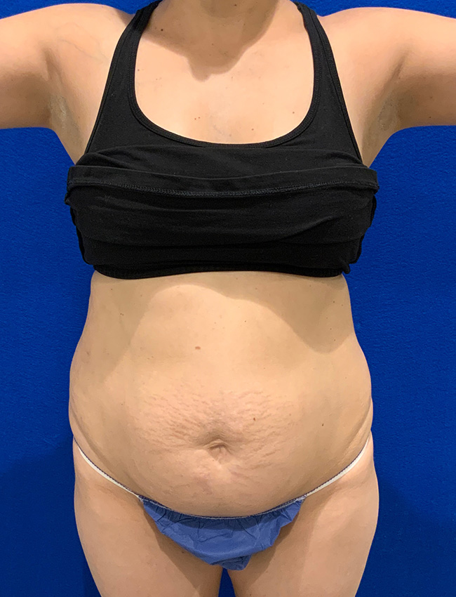 Tummy Tuck